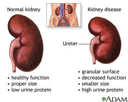 Kidney disease